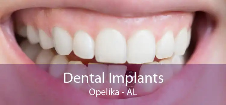 Dental Implants Opelika - AL