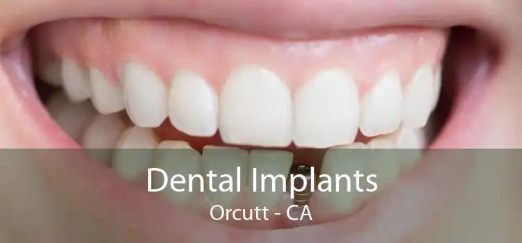 Dental Implants Orcutt - CA