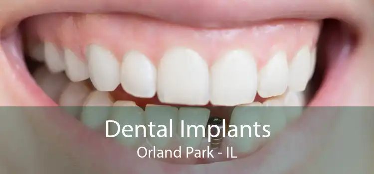 Dental Implants Orland Park - IL