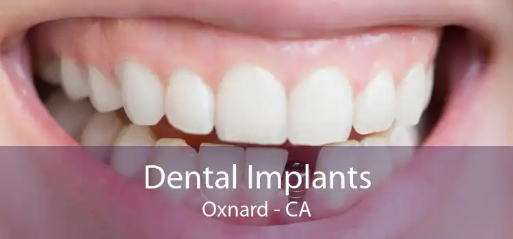 Dental Implants Oxnard - CA