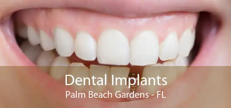 Dental Implants Palm Beach Gardens - FL
