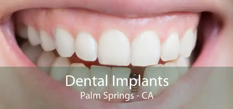 Dental Implants Palm Springs - CA