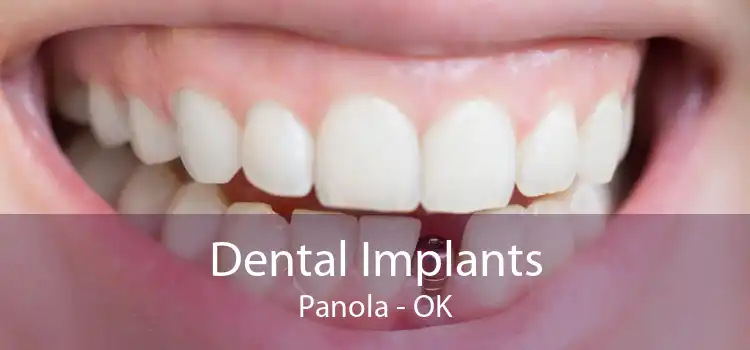 Dental Implants Panola - OK