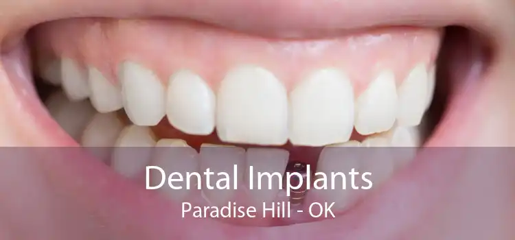 Dental Implants Paradise Hill - OK