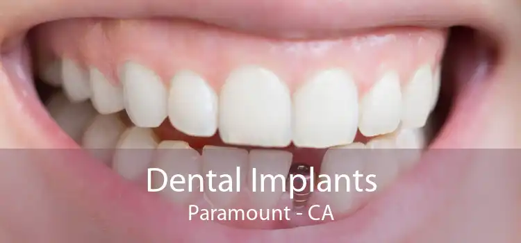 Dental Implants Paramount - CA