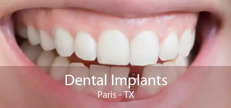 Dental Implants Paris - TX