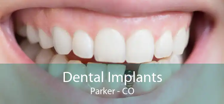 Dental Implants Parker - CO