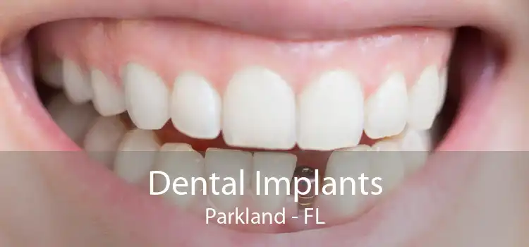 Dental Implants Parkland - FL