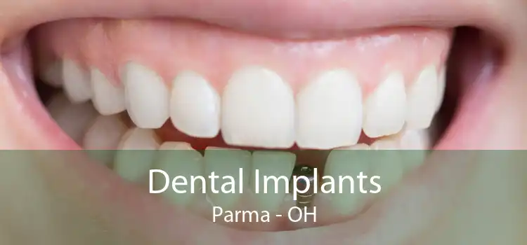 Dental Implants Parma - OH