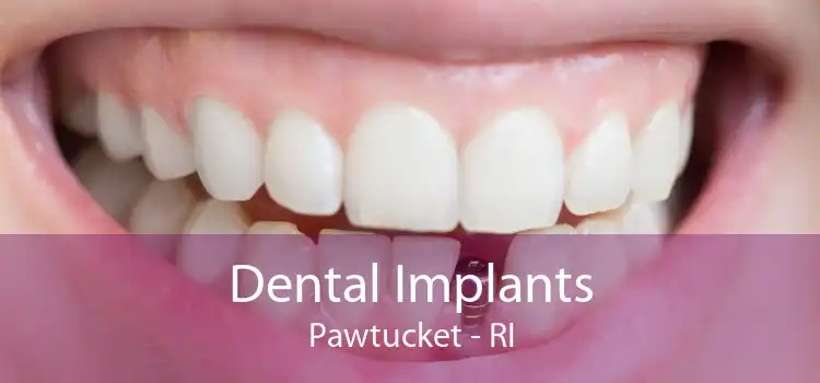 Dental Implants Pawtucket - RI