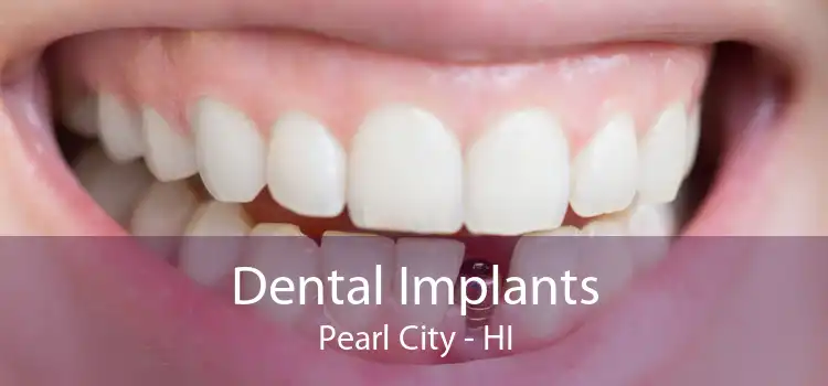 Dental Implants Pearl City - HI