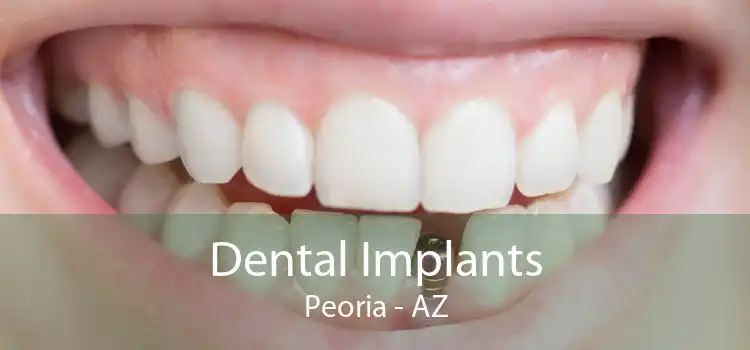 Dental Implants Peoria - AZ