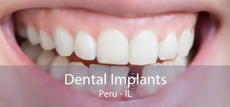 Dental Implants Peru - IL