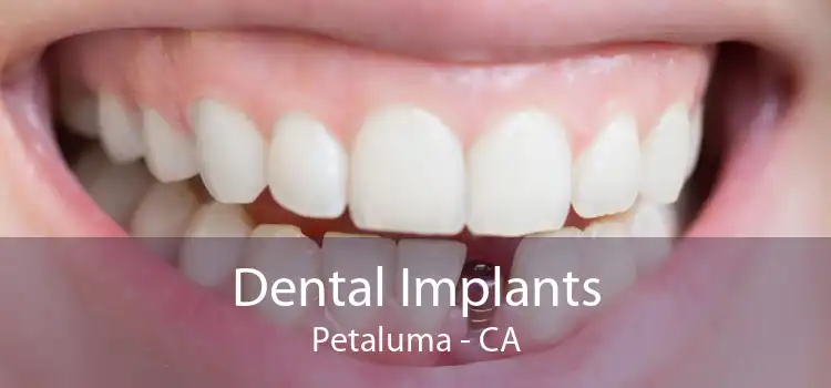Dental Implants Petaluma - CA