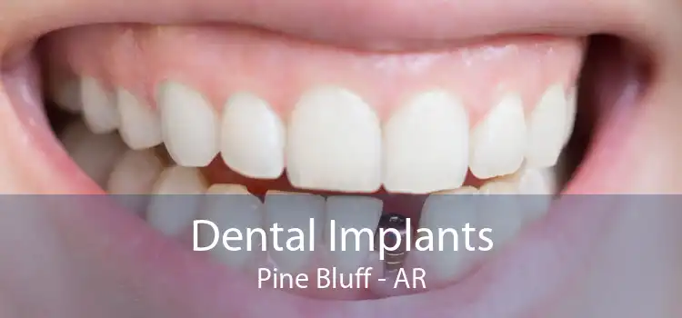 Dental Implants Pine Bluff - AR