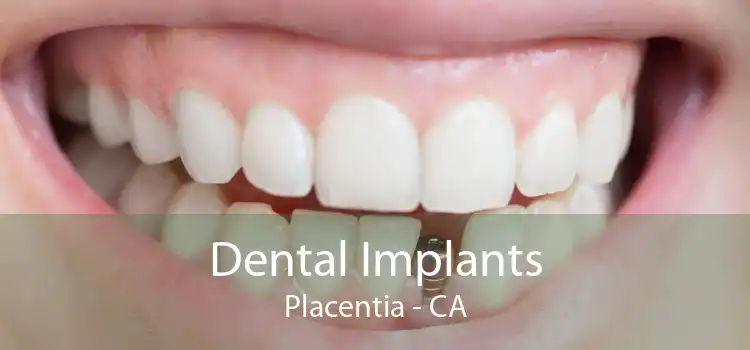 Dental Implants Placentia - CA
