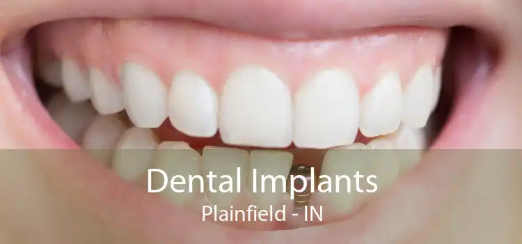 Dental Implants Plainfield - IN