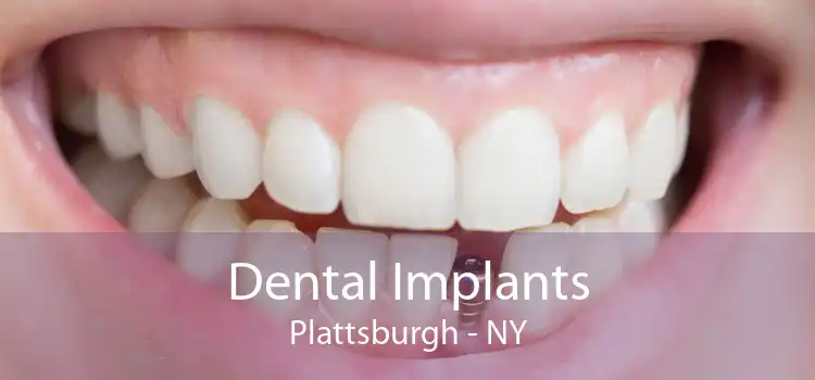 Dental Implants Plattsburgh - NY