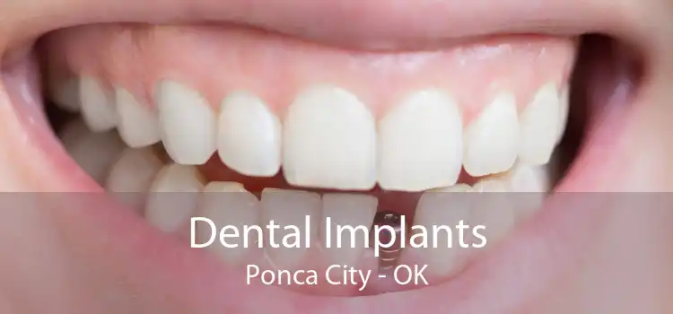 Dental Implants Ponca City - OK