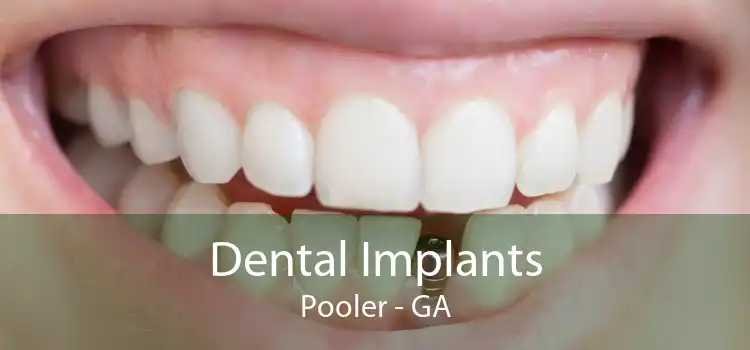Dental Implants Pooler - GA