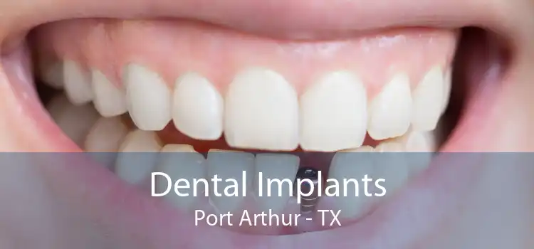 Dental Implants Port Arthur - TX