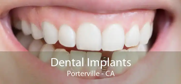 Dental Implants Porterville - CA