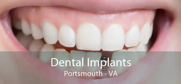 Dental Implants Portsmouth - VA