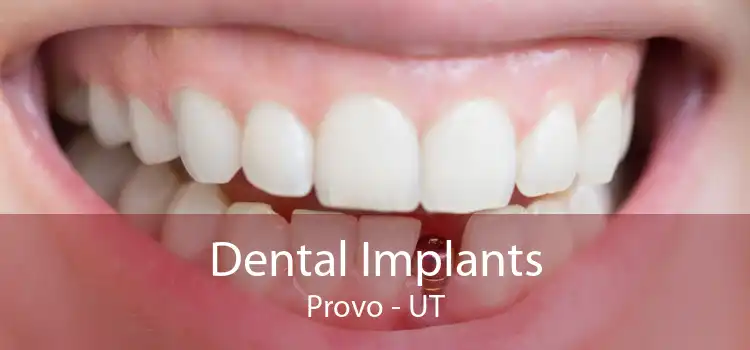 Dental Implants Provo - UT