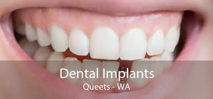 Dental Implants Queets - WA
