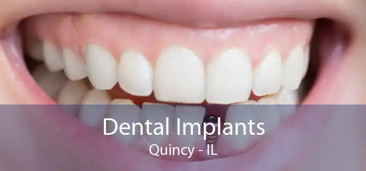 Dental Implants Quincy - IL