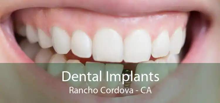 Dental Implants Rancho Cordova - CA