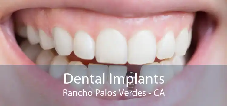 Dental Implants Rancho Palos Verdes - CA