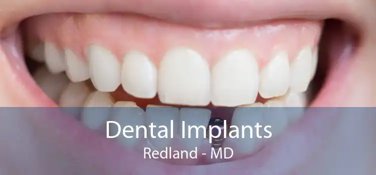 Dental Implants Redland - MD