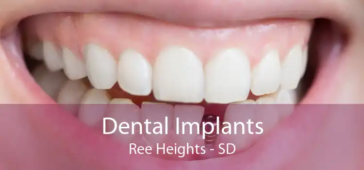 Dental Implants Ree Heights - SD