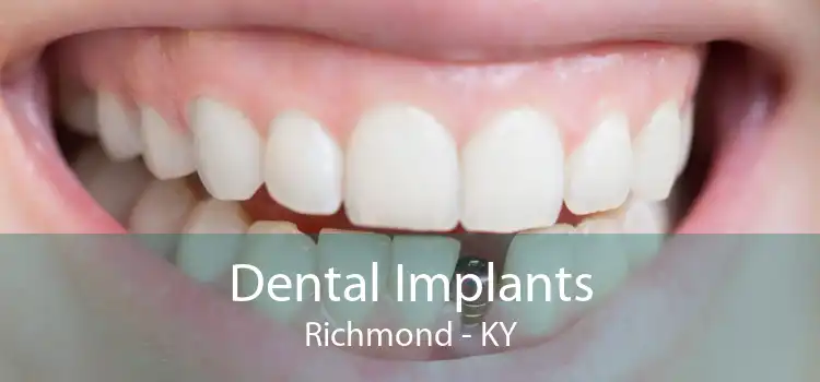 Dental Implants Richmond - KY