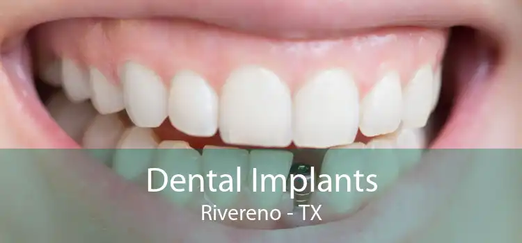 Dental Implants Rivereno - TX