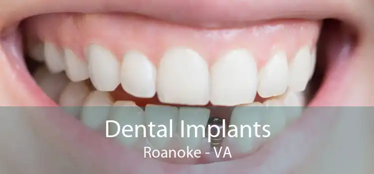 Dental Implants Roanoke - VA