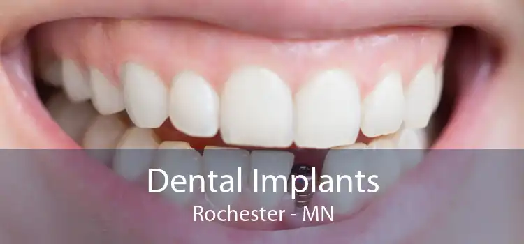Dental Implants Rochester - MN