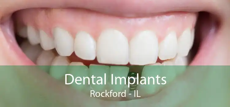 Dental Implants Rockford - IL