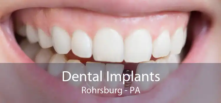 Dental Implants Rohrsburg - PA