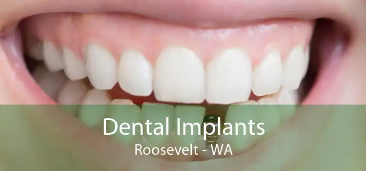 Dental Implants Roosevelt - WA