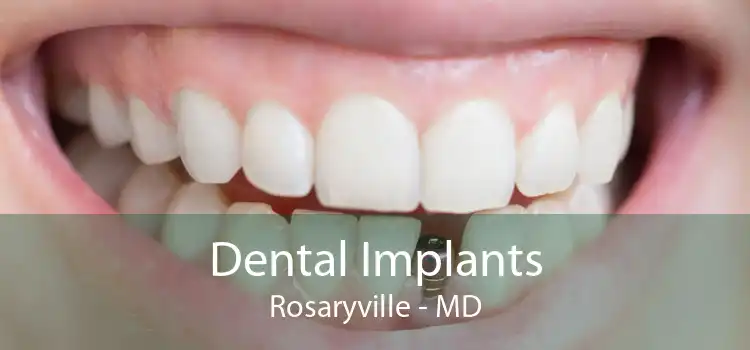 Dental Implants Rosaryville - MD