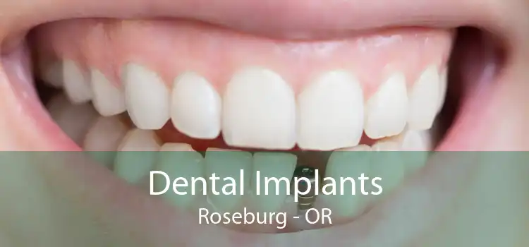 Dental Implants Roseburg - OR