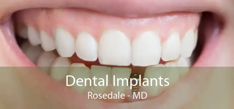 Dental Implants Rosedale - MD