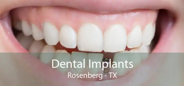 Dental Implants Rosenberg - TX