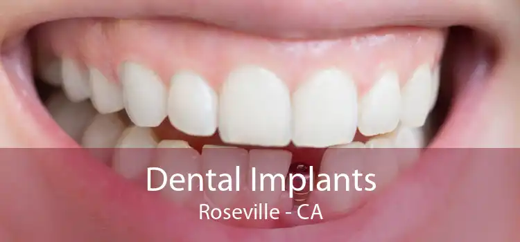 Dental Implants Roseville - CA
