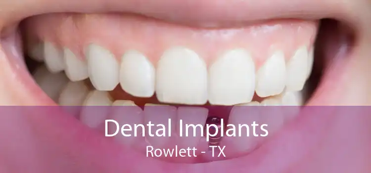 Dental Implants Rowlett - TX
