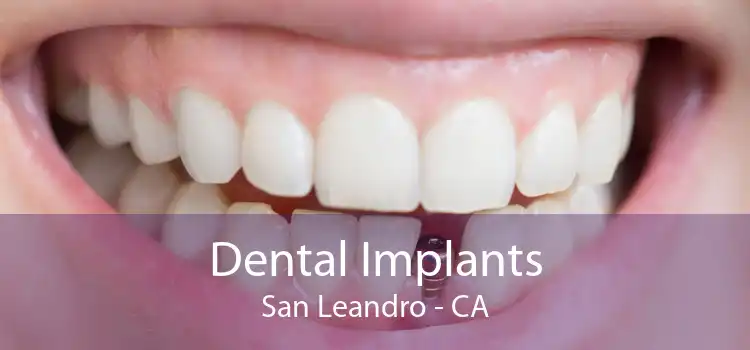 Dental Implants San Leandro - CA