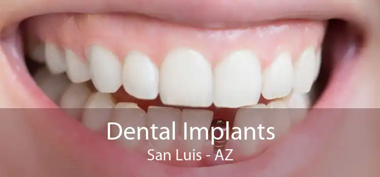 Dental Implants San Luis - AZ