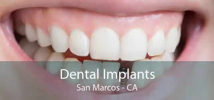 Dental Implants San Marcos - CA